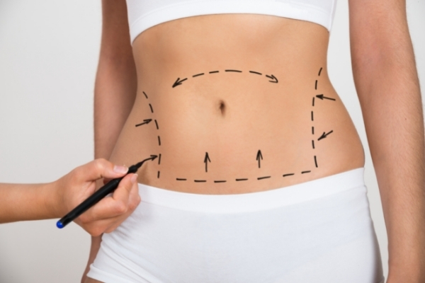 Debunking Common Myths About Liposuction