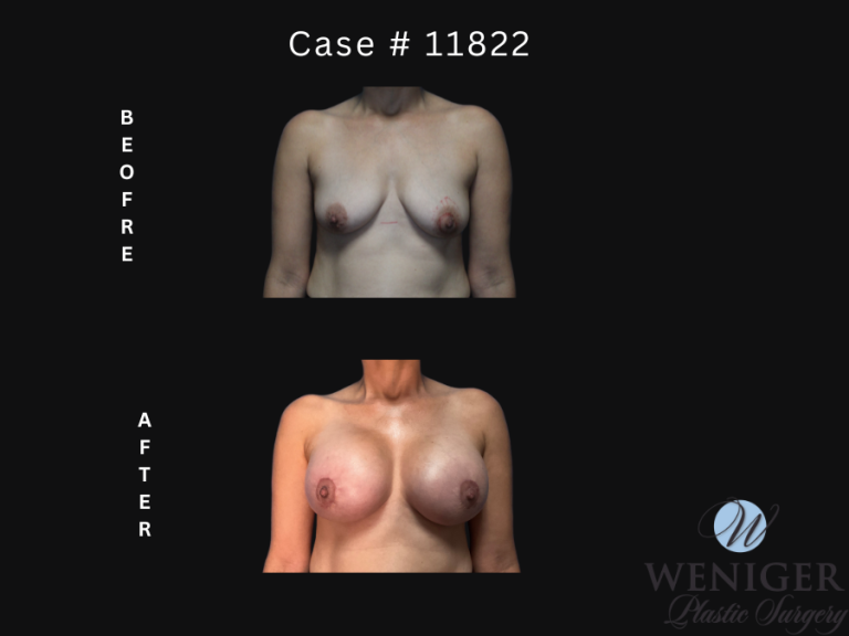 Patient #11822